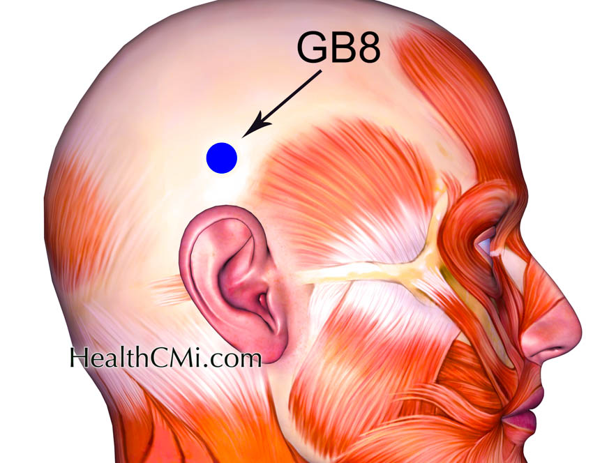 acupunctureceumigraingb8