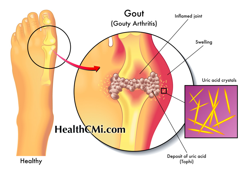 healthcmi goutCEUcourse