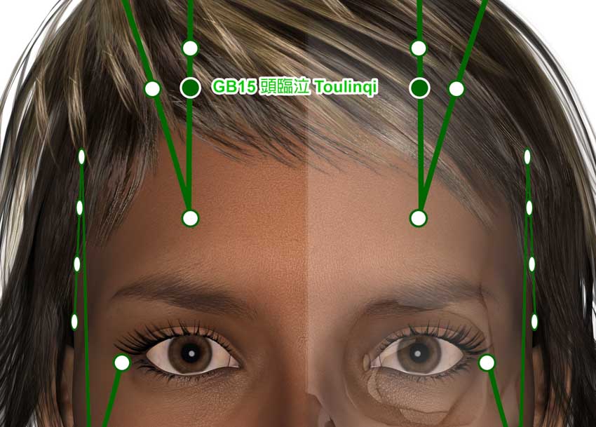 Acupuncture MRI For Schizophrenia