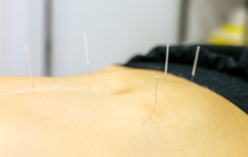 abdominal acupuncture