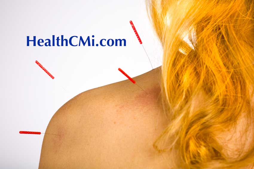 acupuncture ceu shoulder LI15 724