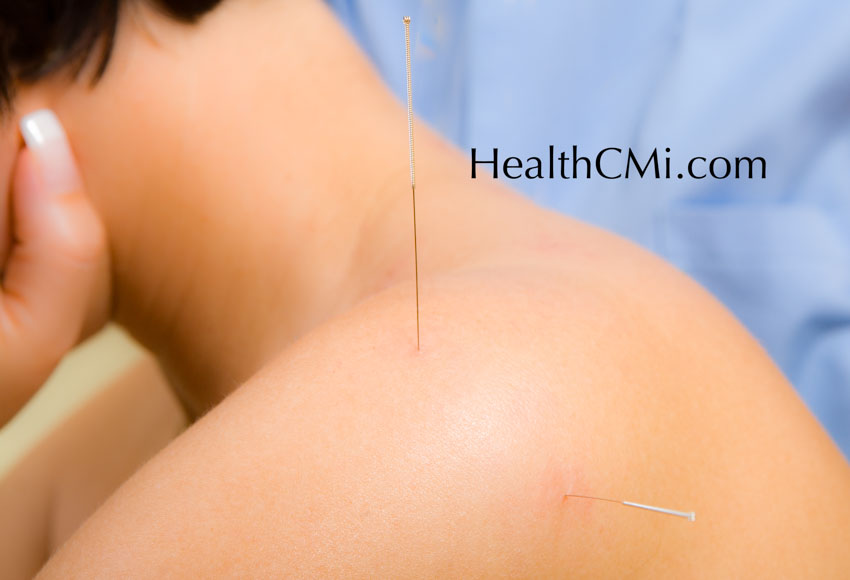 acupuncture continuing ed LI15 TB14