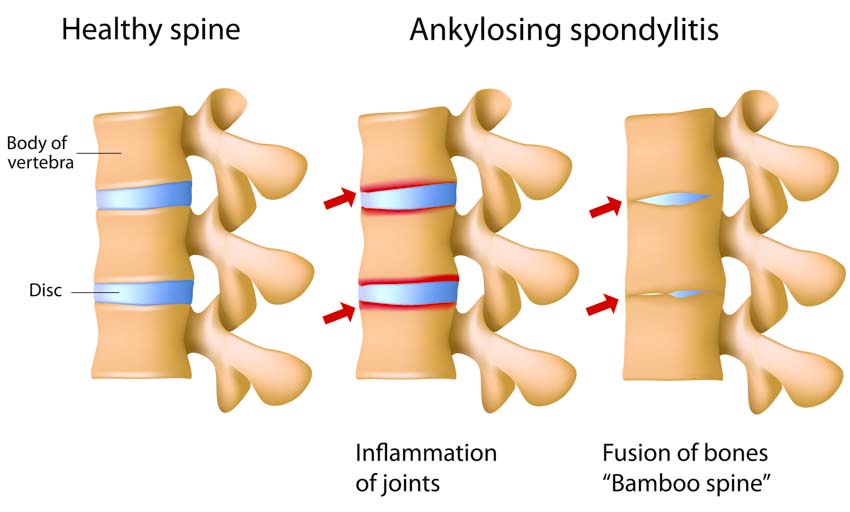 ankylosing spondylitis