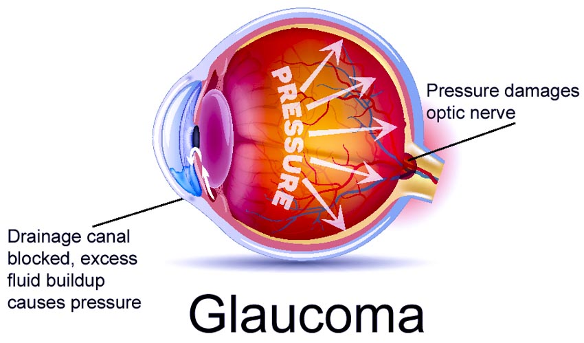 glaucoma