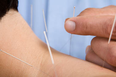 Needling of the neck.