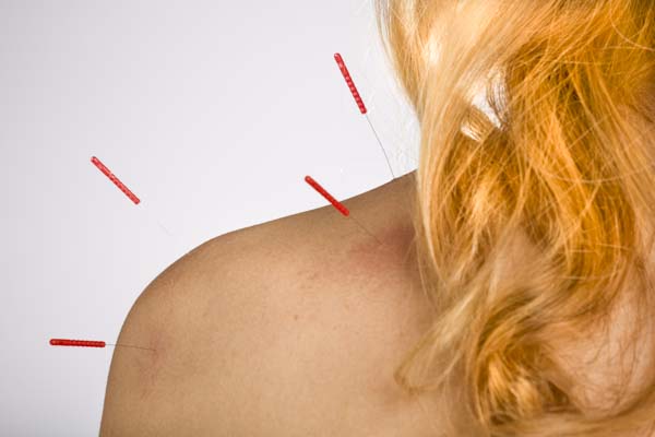 Hui style acupuncture involves application of Ashi points.