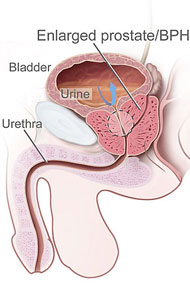 Enlarged prostates are treated with acupuncture points.