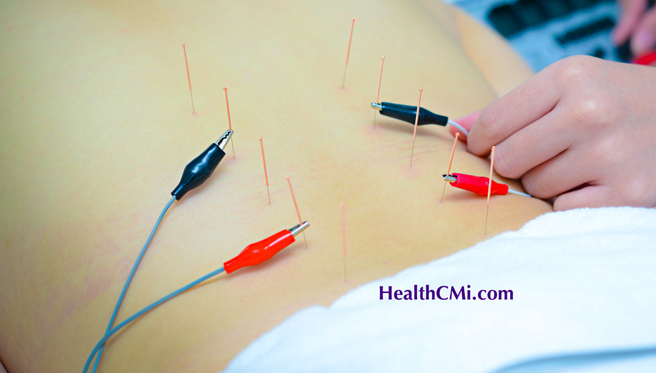 acupuncture ceu sciatica herniated111024