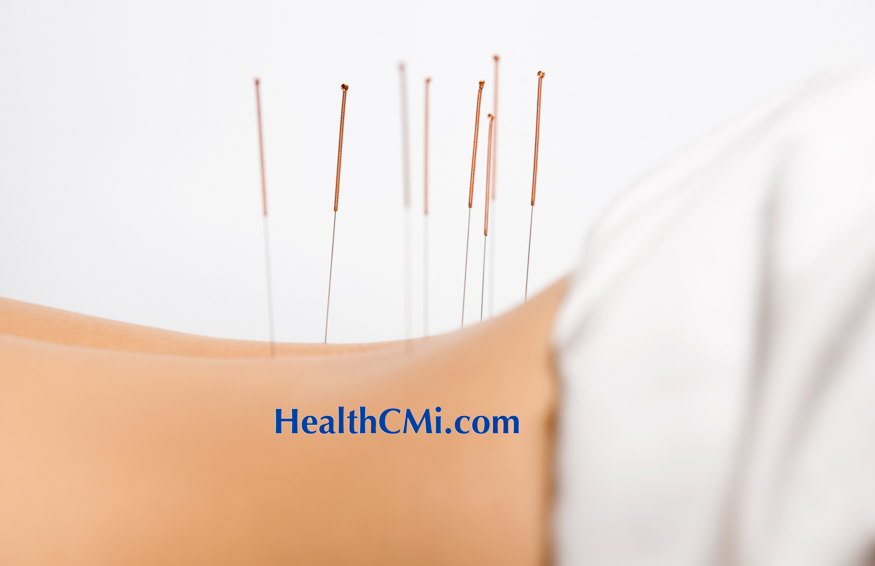 backacupuncturetx