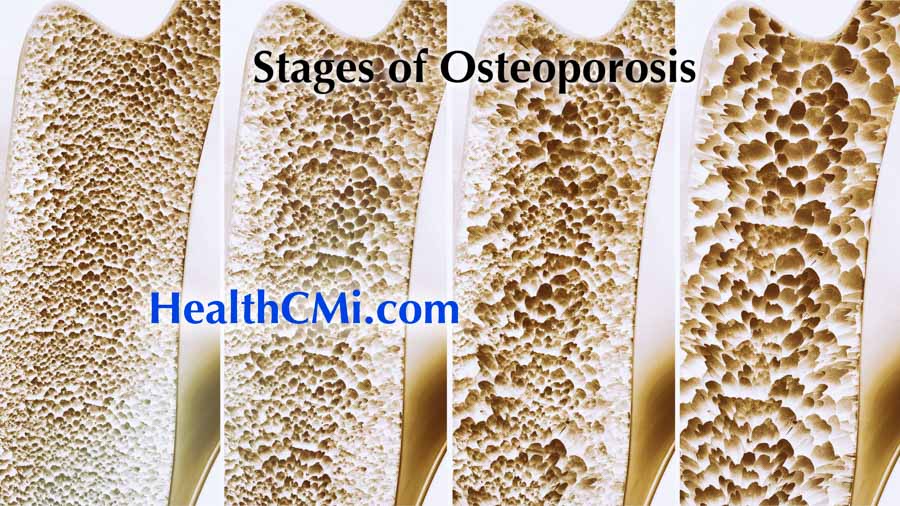 healthcmi ceus osteo warm