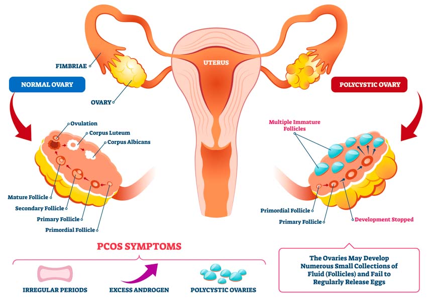 PCOS chart