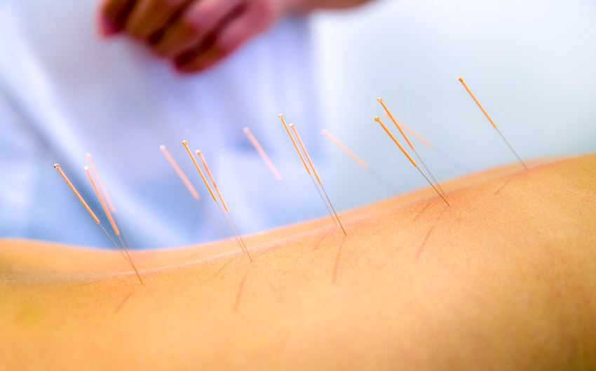 acupuncture ceu fibromy