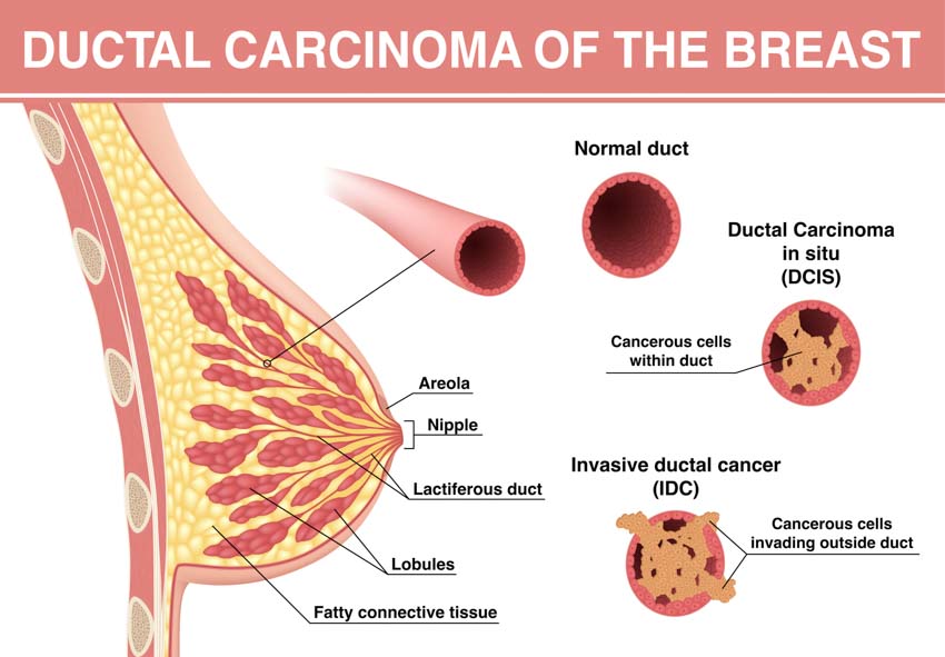 adenocarcinoma20082321