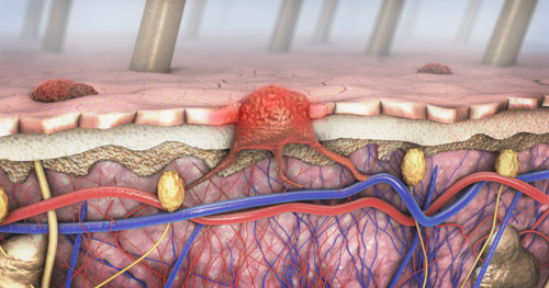 melanoma oncology