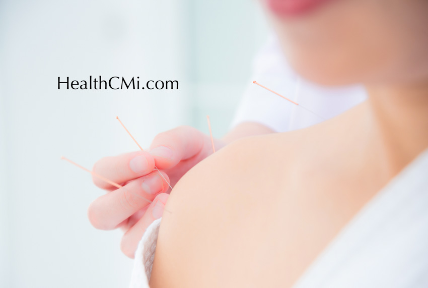 shoulderacupuncture