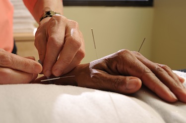 Hand acupuncture. 