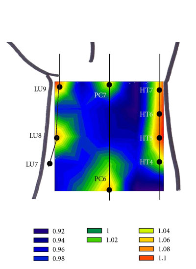 High pressure oxygen at acupuncture points of the wrist. 